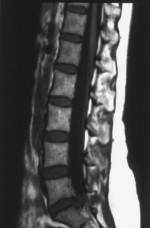 MRI of Spine