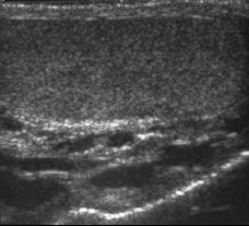 Varicocoele Ultrasound (1)