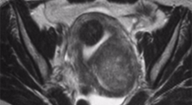 Fibroid-MRI-Axial-228x151
