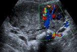 Ultrasound-scan-of-pelvic-varicose-veins